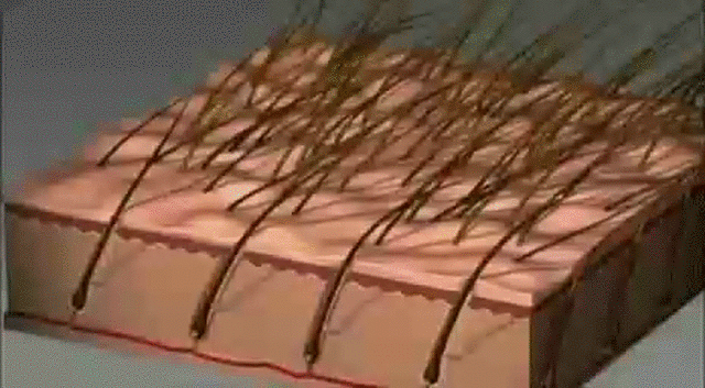 Permanent Hair Removal, Unwanted Hair Growth Solution