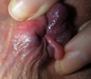 Permanent Hair Removal Cost, Hair Removal Unwanted Punjab